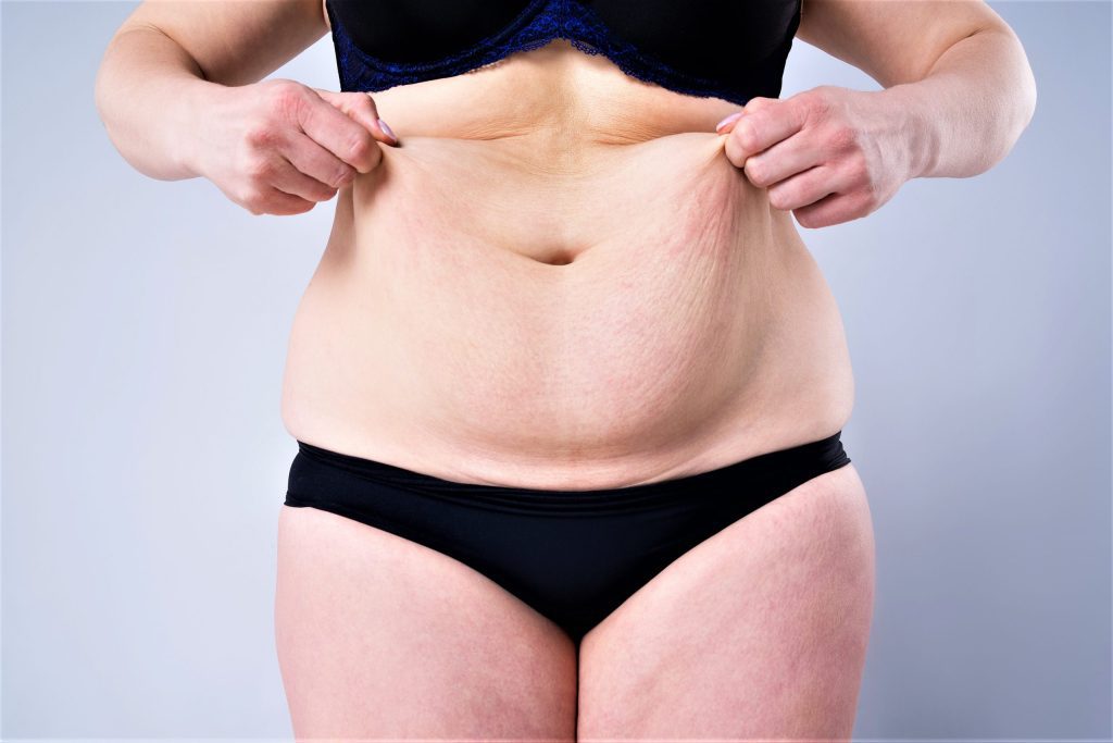 A stomach of a woman showing its excess fats.