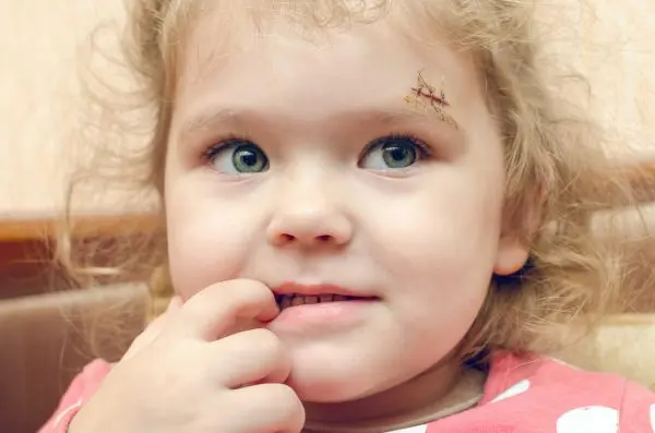 A little girl with a stitch from her upper left brow due to injury.
