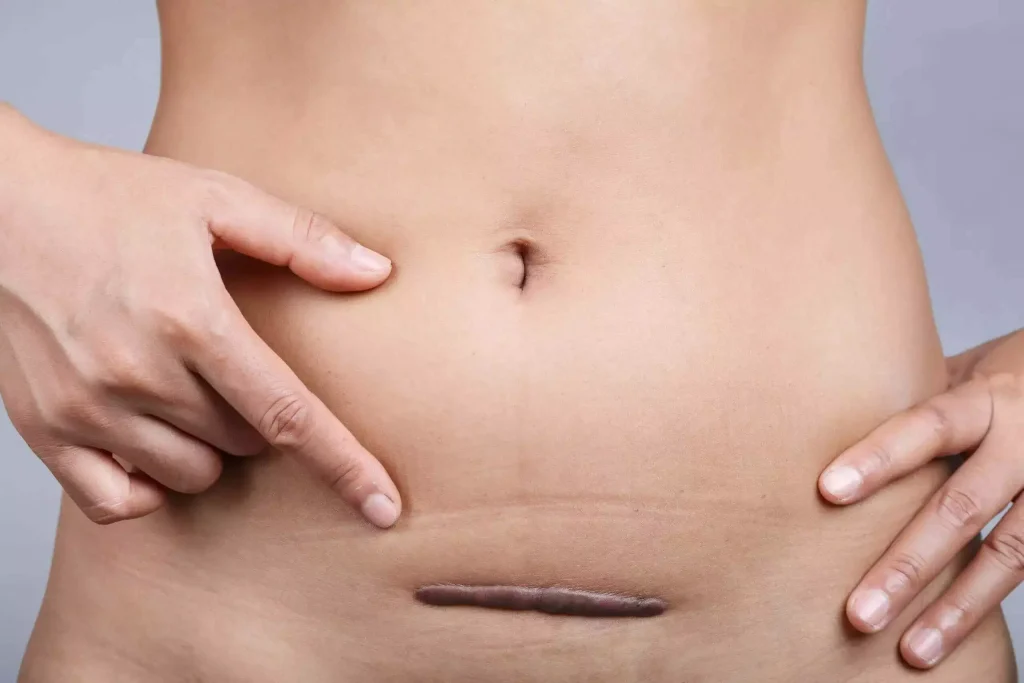 Keloid Surgery in Singapore