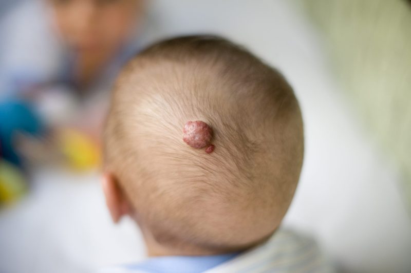 Hemangioma in the head Picasso Plastic Surgery