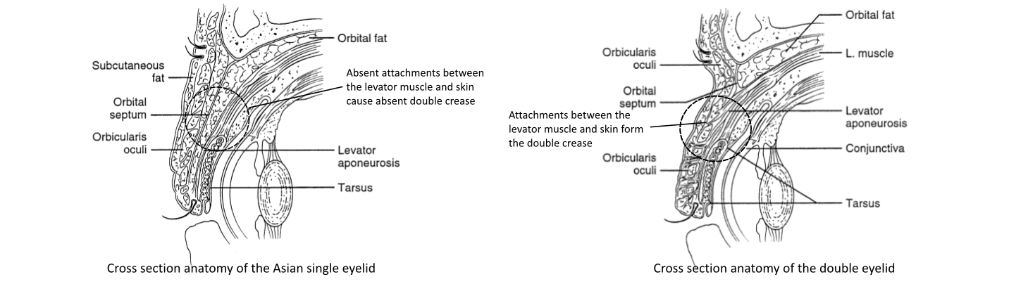 Anatomy of the Asian vs Occidental eyelid