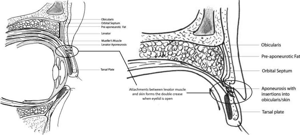Cross section diagram of Western eyelid with crease