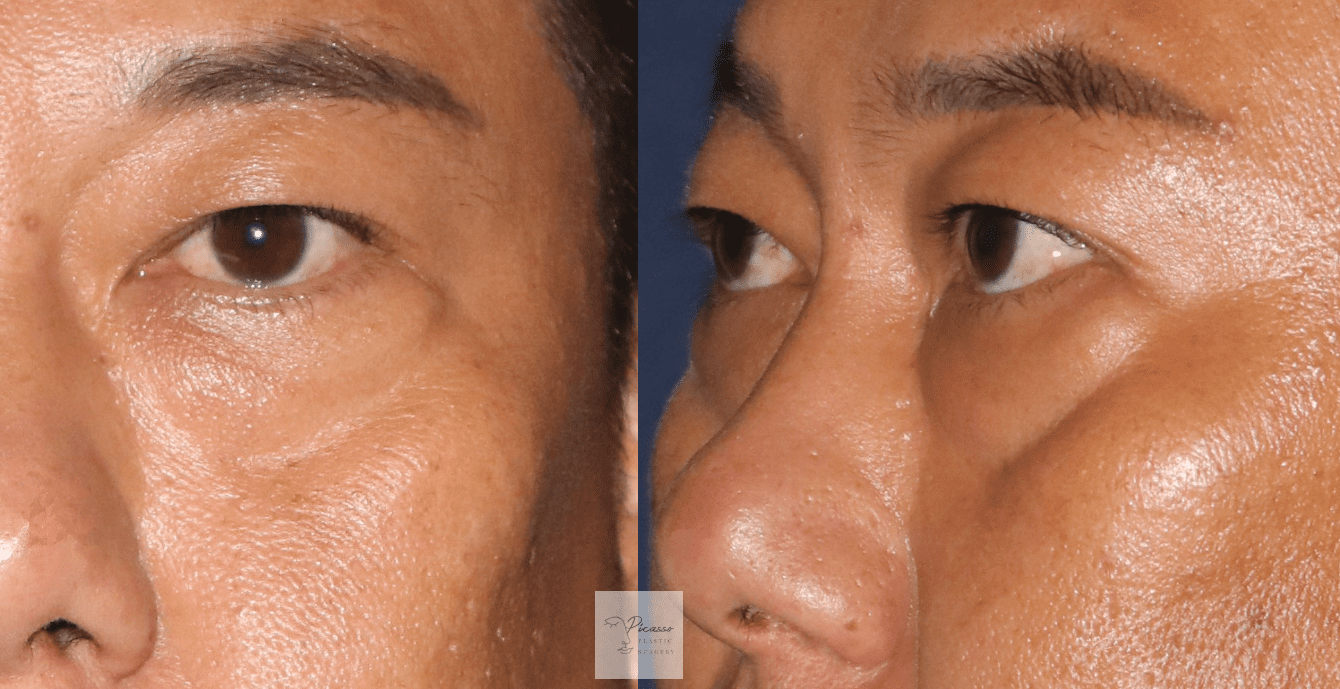 Eyebags and tear troughs