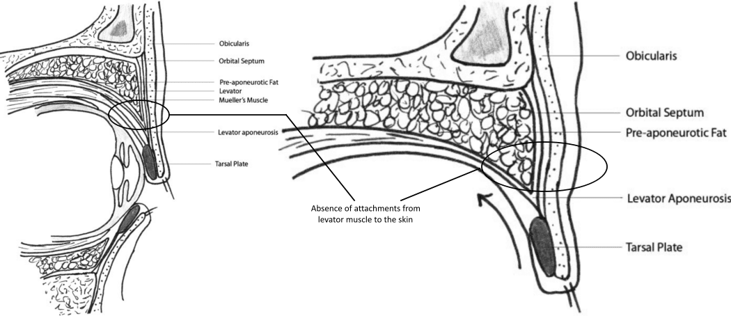 Cross section diagram of Asian upper eyelid without crease