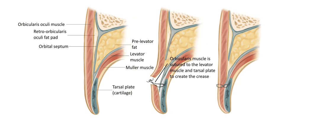 Double eyelid Asian blepharoplasty cross section diagram