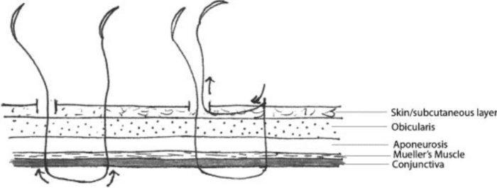Cross section diagram of minimal-incision upper blepharoplasty technique.png