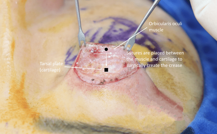 Surgical crease creation