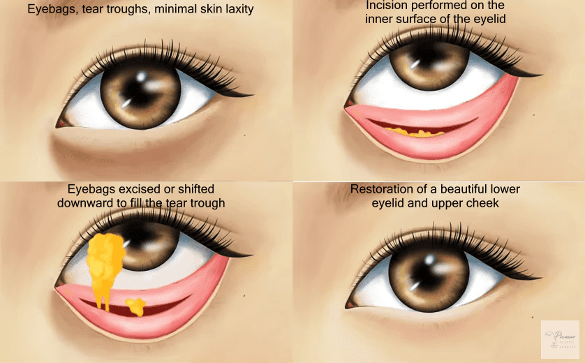 Transconjunctival (inner) lower blepharoplasty