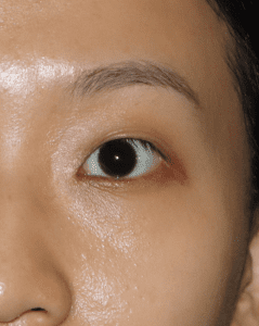 Congenital single eyelid