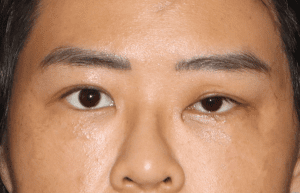 post trauma loss of crease and ptosis