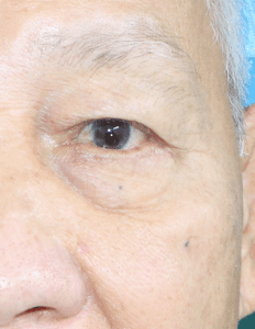 skin excess (dermatochalasis), ptosis and loss of crease