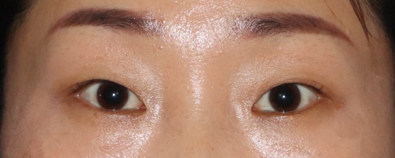 What is Double Eyelid Surgery and How Does It Work