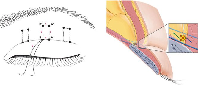 Minimal-incision surgery