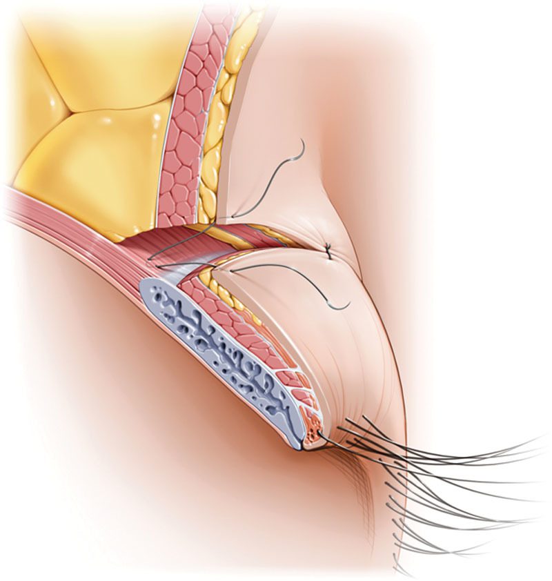 Open-incision surgery